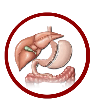 Gastric Sleeve