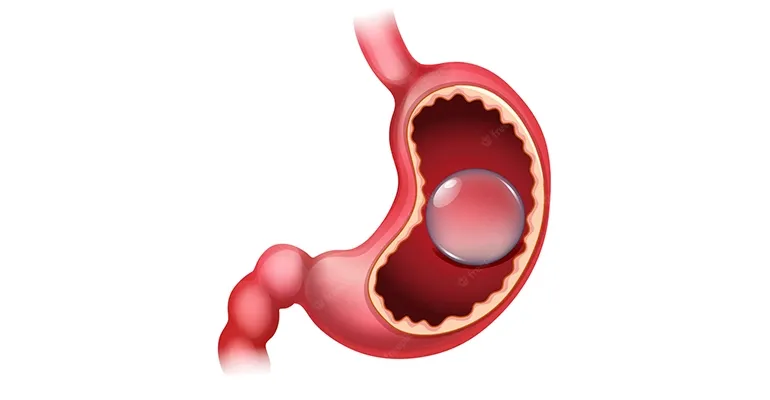 Swallowable Gastric Balloon